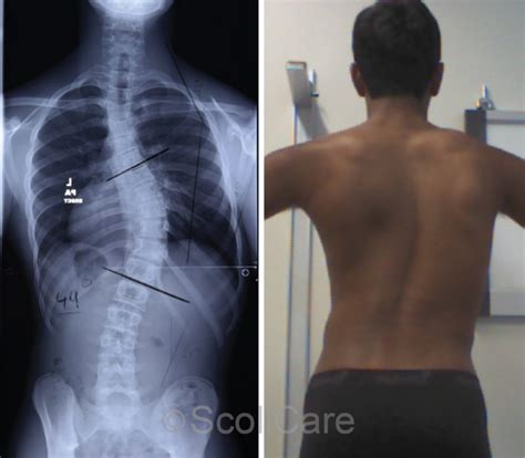 scoliosis dating site